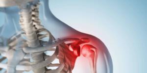 Omuz Sıkışması Tedavisi